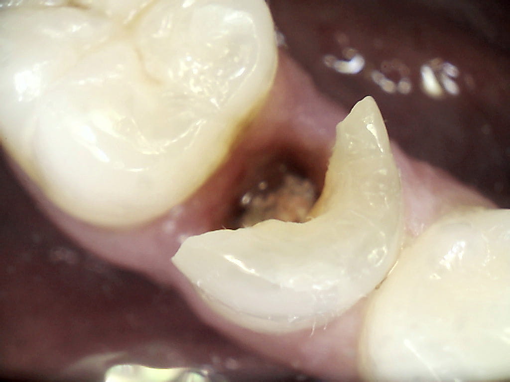 CS 1500 klinisk billede — okklusal fraktur dokumenteret med RGB